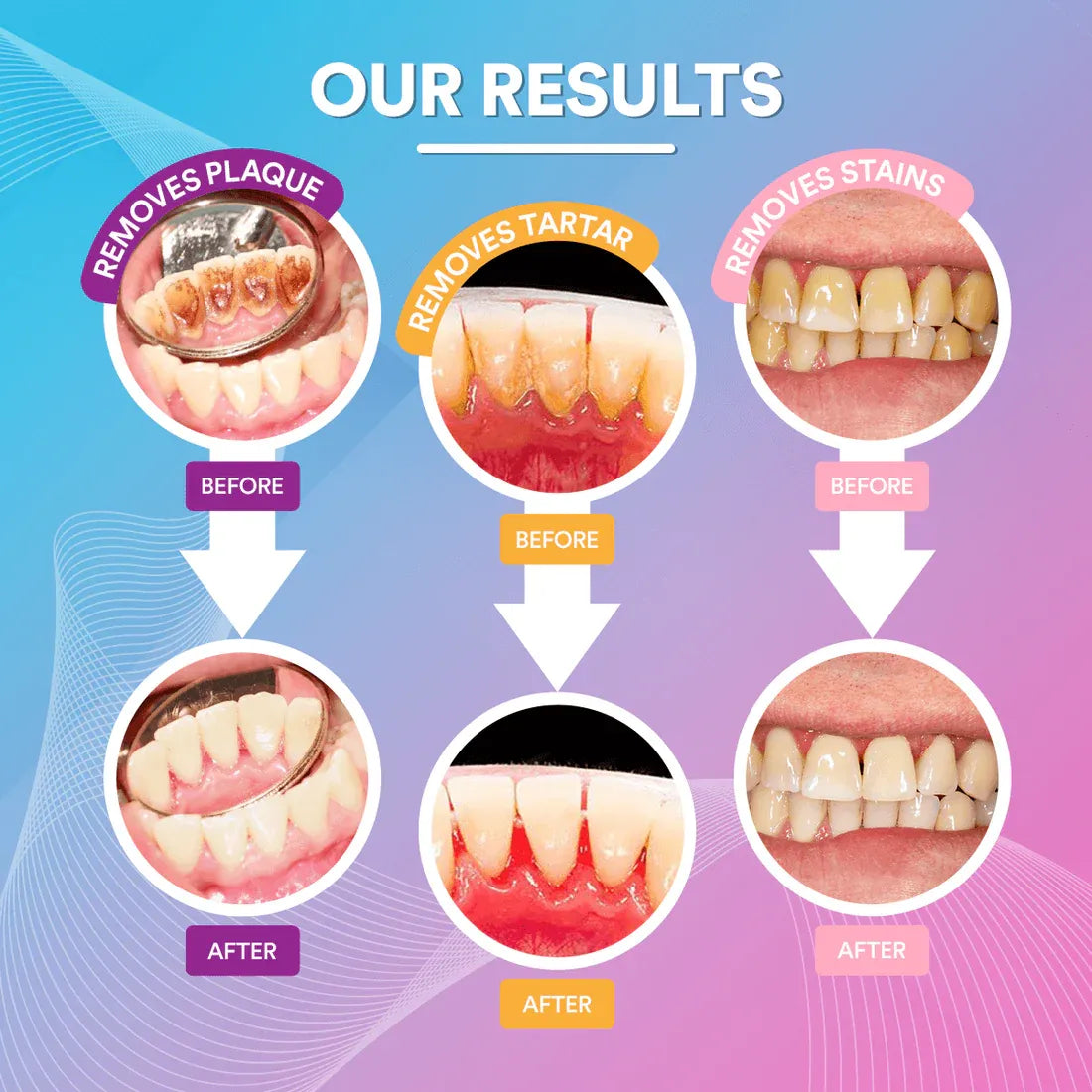 Ultrasonic Tooth Cleaner