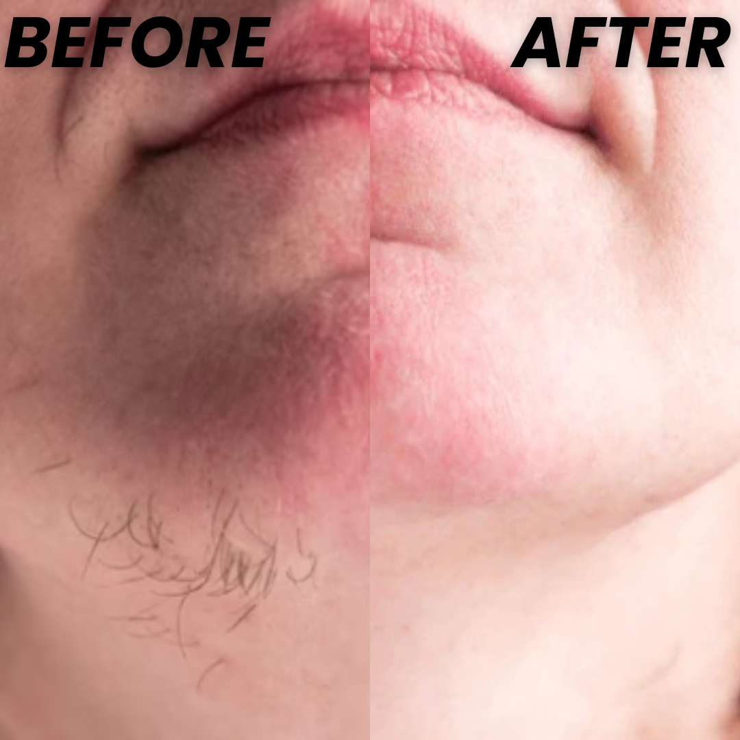 Rhenford - Facial Hair Removal Kit
